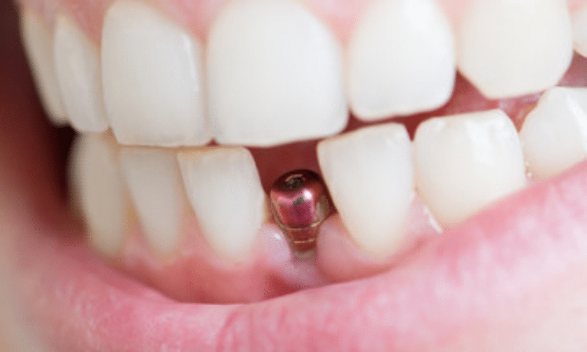 Dental implants advanced technology