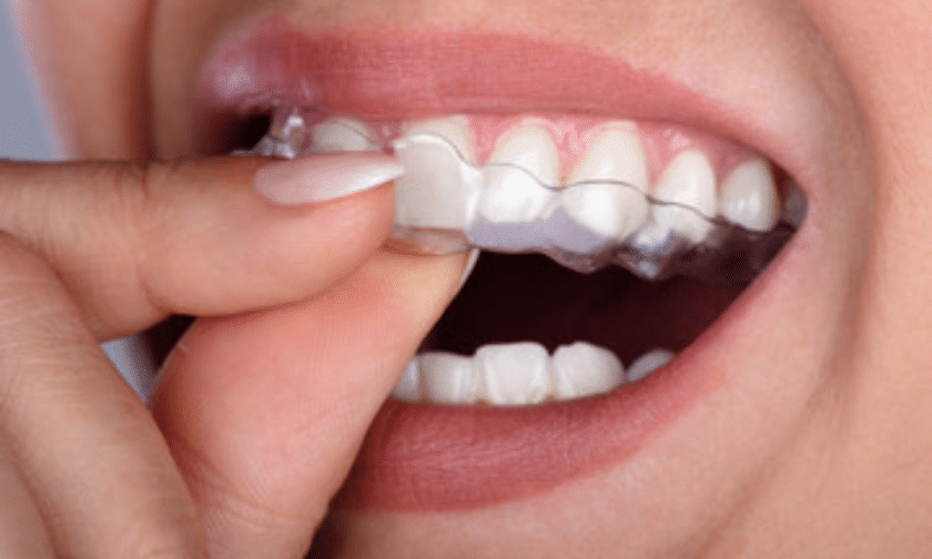 Know about clear aligners in Yuma.