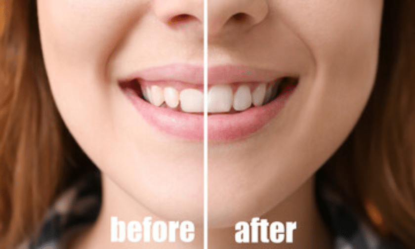 Learn about gum contouring treatment